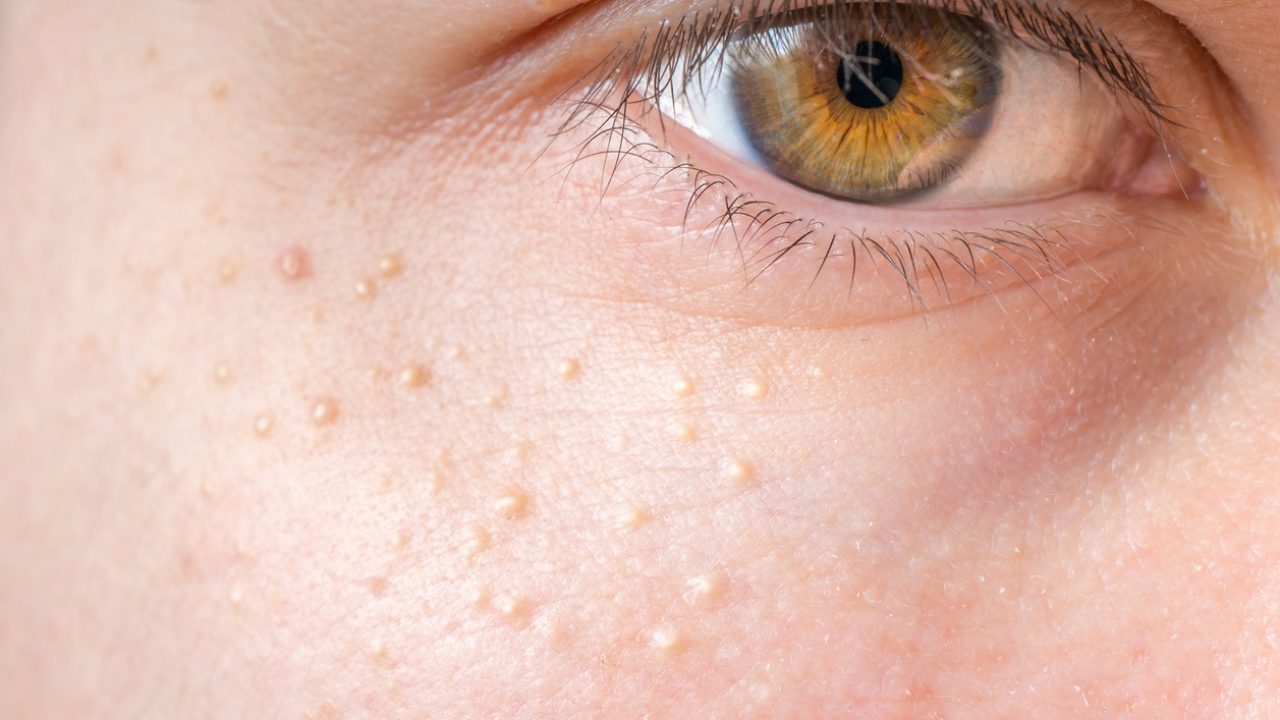 What Is Milia What Causes It And How To Get Rid Of The Spots Mamabella