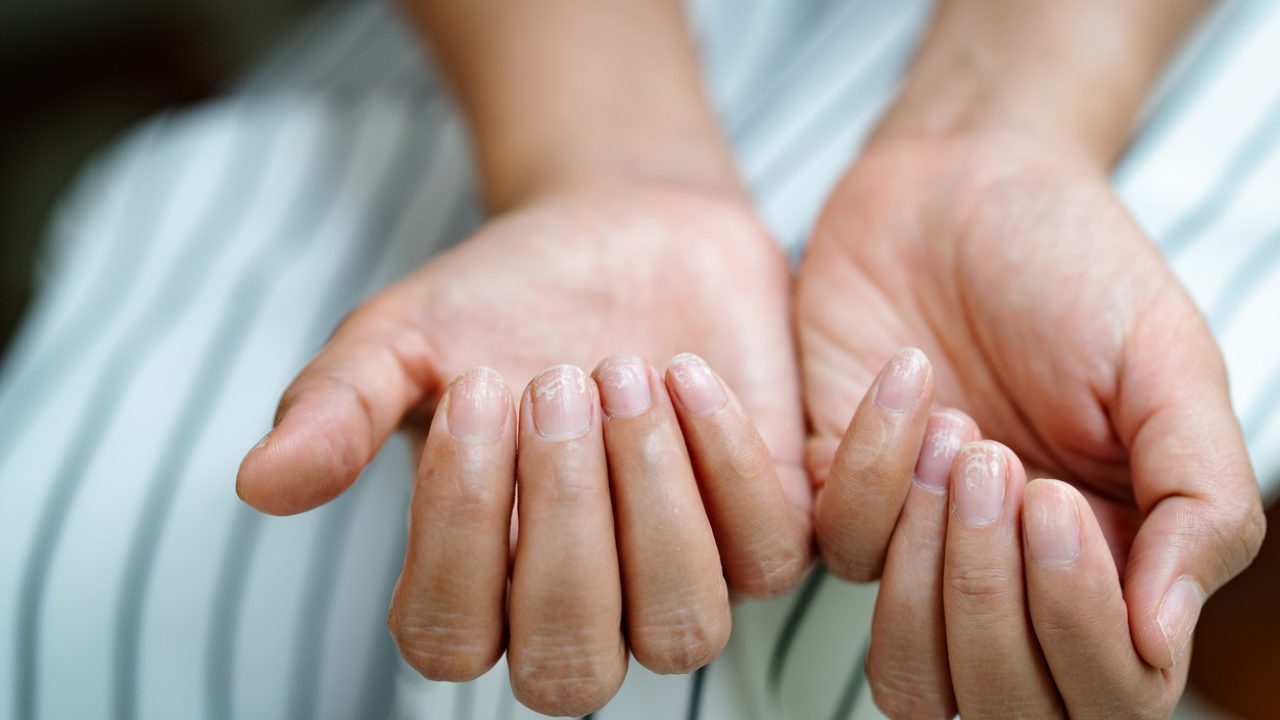 How to strengthen nails and brittle nails causes