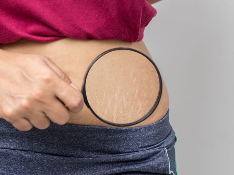 How to get rid of stretch marks and causes
