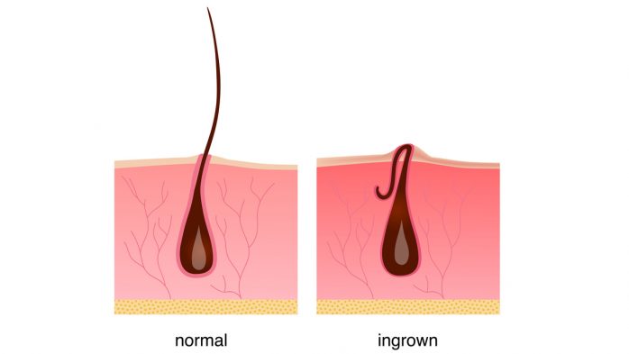 Ingrown hair after shaving, cream or epilator. Anatomy infographics of hair vector illustration. Beautiful legs.