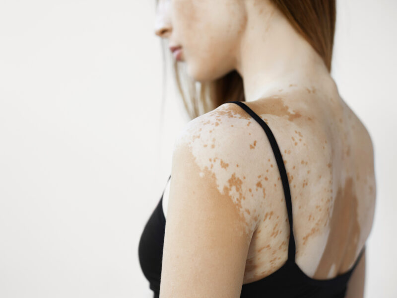 vitiligo causes and skin condition vitiligo treatment