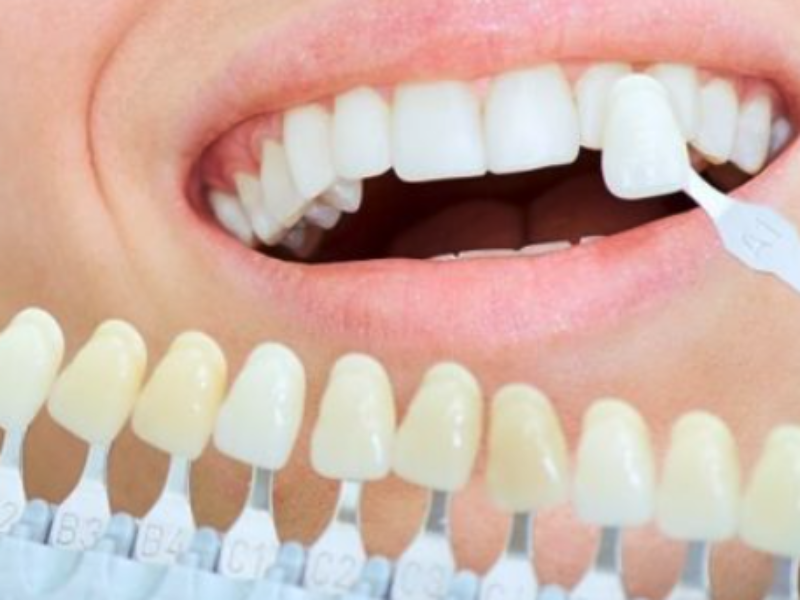 Teeth veneers everything you need to know