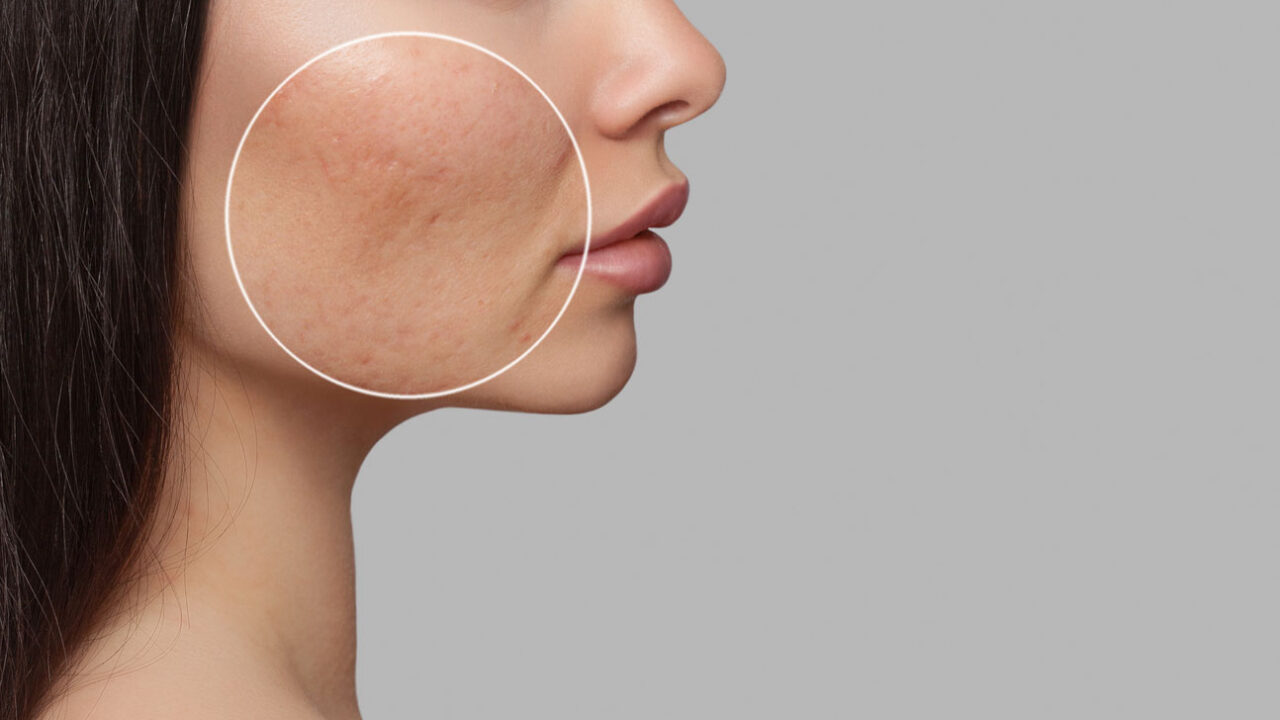 Pores-how-to-minimise-shrink-and-reduce-pores-on-the-face-and-nose