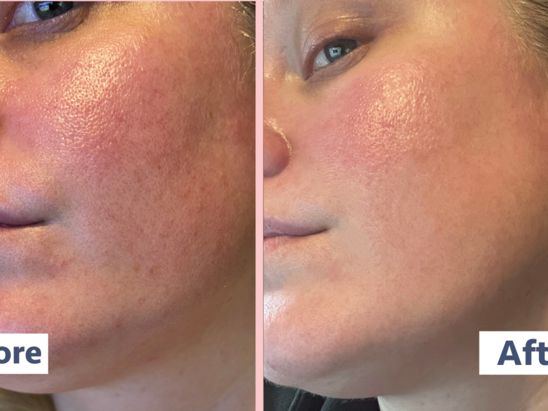 Paula's Choice Exfoliant Review Before and After