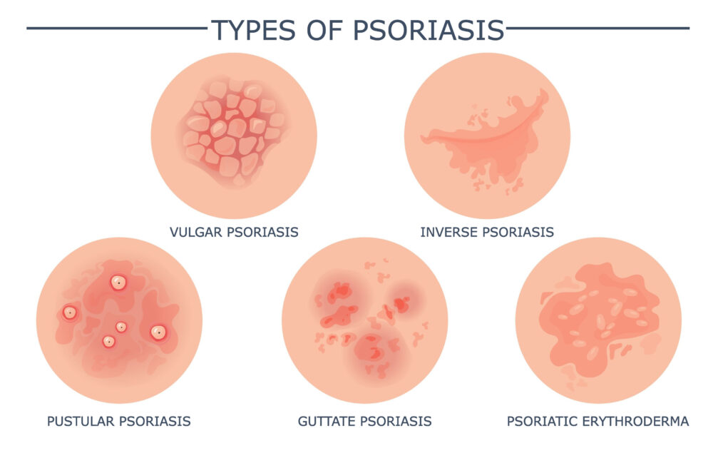 What does psoriasis look like