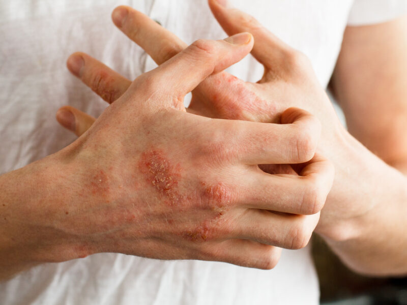 What is psoriasis, what causes it and can you cure it permanently