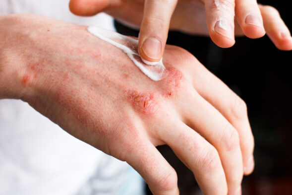 How to cure psoriasis permanently