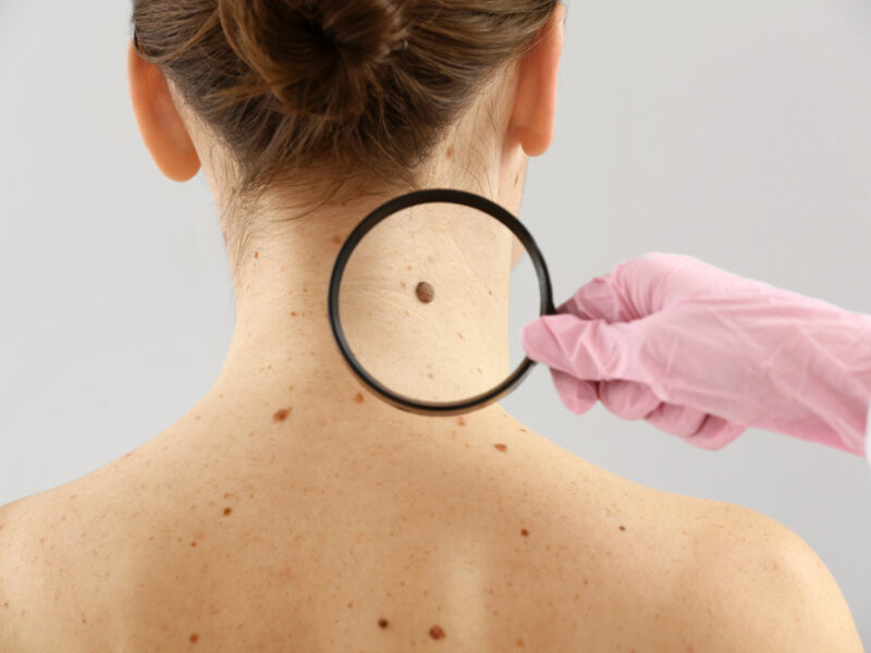 Skin cancer types and how to check for skin cancer