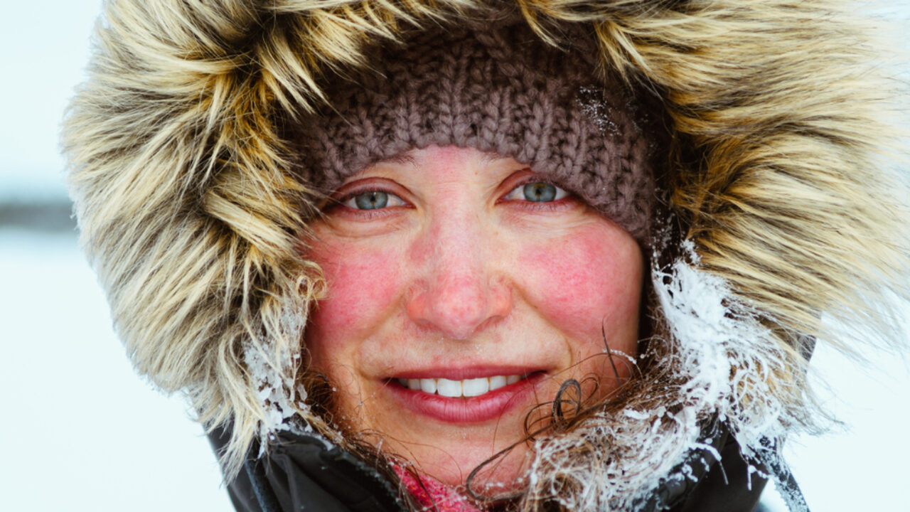 How to get rid of winter rash and winter itch