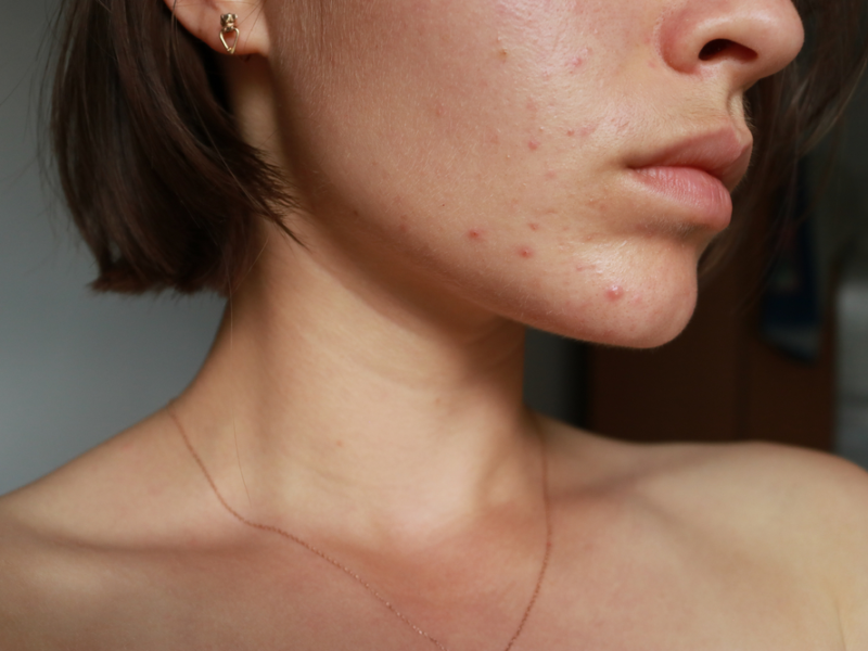 Adult acne causes and how to treat it