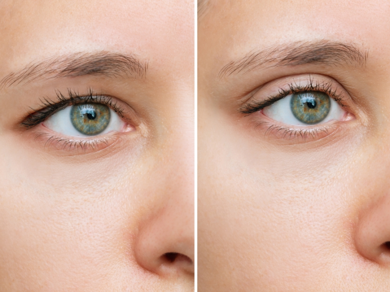 Blepharoplasty eyelid surgery before and after
